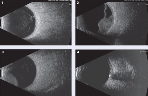 These are a few examples of the pathologies that can be imaged using B-scan ultrasonography. 