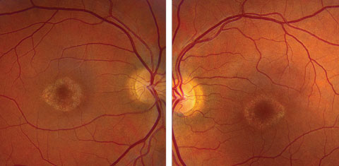 Figs. 1a and 1b. Fundus photos of the right and left eye of our patient. What do the changes in her macula represent?