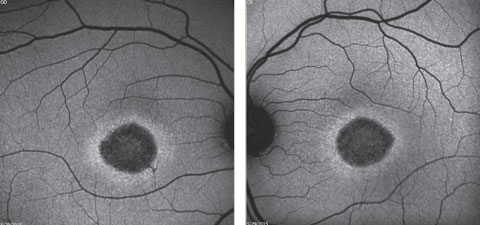 Figs. 2a and 2b. Fundus autofluorescence of the right and left eye. How do these correlate with the fundus images?
