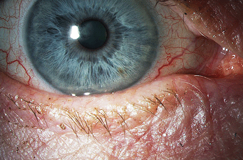 The clinical appearance of the ocular surface and lid in the same eye.