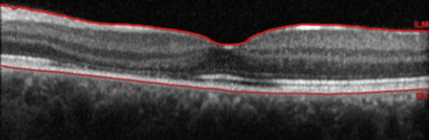 Can this SD-OCT of the patient’s left eye help yield the diagnosis?