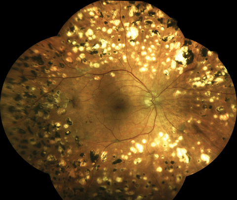 Taken with an an Eidon True Color Confocal Scanner, this image shows a patient following extensive panretinal photocoagulation for proliferative diabetic retinopathy.