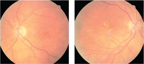 At left, this eye qualifies as intermediate AMD per the AREDS classification system. This is a patient who would benefit from supplementation per the AREDS data. In the image at right, the patient qualifies as intermediate AMD and is progressing to the advanced stage due to the pigment clumping centrally.