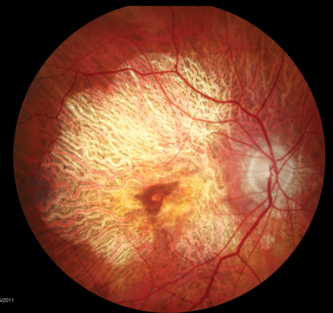 Dry AMD patients require ongoing education about nutrition and other influences on their ocular status.
