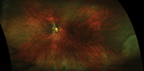 Ultra-widefield image of clinically diagnosed inferior retinal break with shallow retinal detachment not apparent in image.