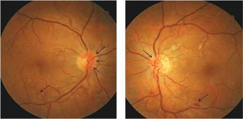 Figs. 1a and 1b. These fundus photos display our patient’s disc edema (as shown with the black arrows) more prominent nasally and in the right eye than in the left.