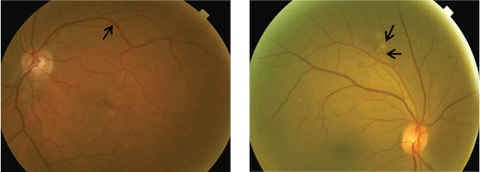 At left, this fundus image shows arteriovenous crossing changes along superior temporal arcades. At right, this fundus images shows hypertensive retinopathy with retinal hemorrhages and cotton-wool spots.