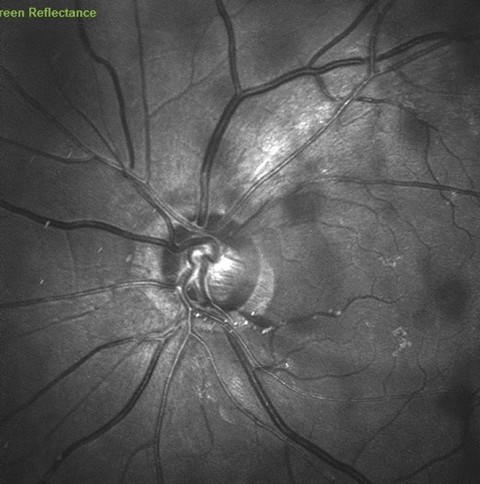 Green laser image of the left optic nerve, demonstrating a disc hemorrhage at 4 o’clock and an adjacent wedge defect at 5 o’clock.