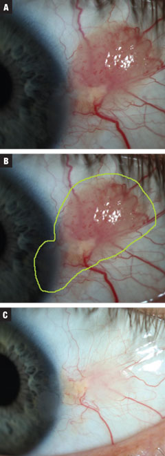 Fig. 3a. Case 3 involved a moderate-sized presumed papillomatous CIN. The patient was started on treatment INF-a2b three million IU for 10 days. Fig. 3b. Estimated total lesion size. Fig. 3c. Post treatment. Near complete resolution of growth with continued irregular corneal epithelium. Against advisement, the patient opted to observe at this time. 