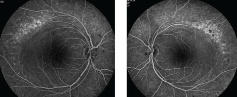 Figs. 4a and 4b. Do our patient’s intravenous FA images reveal anything about his likely diagnosis?