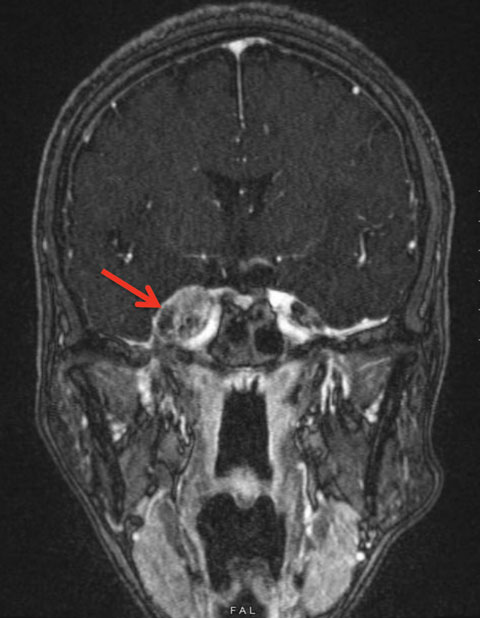 Fig. 2. This is our patient’s FLAIR MRI with contrast of the head. The red arrow is pointing to the 2.1x1.6x2.4cm peri-sphenoid lesion abutting the right cavernous sinus and involving right Meckel’s cave.