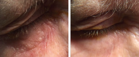 This patient’s neomycin ointment hypersensitivity of the right eyelid (left) was resolved (right) with topical FML 0.1% ointment applied BID OU for four weeks.