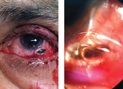This 57-year-old patient’s left eye shows the result of a blunt trauma. Can you diagnose him?