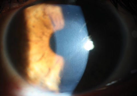 Using a slit lamp, clinicians can see CXL-associated corneal haze distributed within the treatment zone. 