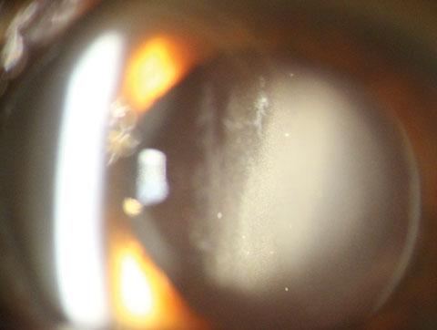 Evidence of the white debris (medication) in the anterior vitreous one day after cataract surgery.