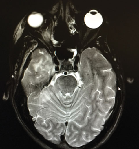 Our patient’s axial MRI shows residual orbital congestion and inflammation post extensive sinus tissue resection.