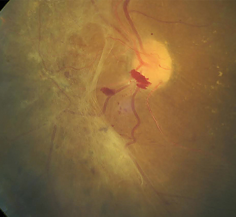 This patient shows a large area of preretinal fibrosis and a small amount of preretinal hemorrhage. The macula demonstrates exudate with macular edema. Photo: Erik Hanson, MD