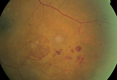 A large area of retinal neovascularization, also known as neovascular elsewhere (NVE), exists. The superotemporal vein demonstrates an omega loop, a strong indicator of retinal hypoxia. 