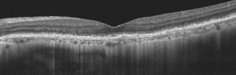 This 77-year-old patient’s OCT demonstrates ARAC. The PIL line is intact with slight RPE mottling. 