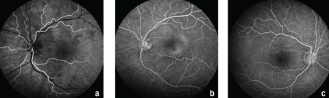 Fig. 4. Fluorescein angiography shows (a) hypofluorescence superior to the optic disc and around the left macula in the early phase, (b) mottled hyperfluorescence, known as “leopard spotting,” in the area of the plaque lesion in the late phase in the patient’s left eye and (c) normal fundus appearance during the late phase in the right eye.