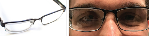 Figs. 3 and 4. At left, J.F.’s lenses had significantly different thickness, yet they made a huge difference in his aniseikonia. At right, note the amount of the shift inwards of the right side of J.F.’s head in the temporal portion of his glasses and the lack of shift in the left side of his face. 