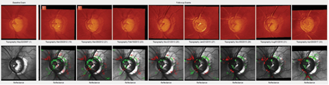 The patient’s HRT 3 scans of her left eye over the past 10 years showing marked stability of her neuroretinal rims in the presence of advanced glaucoma.