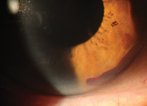 Hyphema is one of a few postoperative complications to consider with MIGS. 