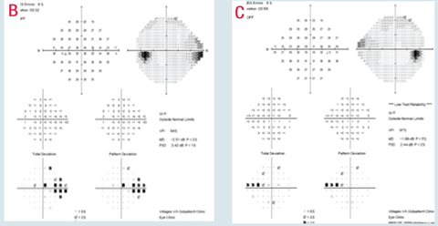 This patient has detectable rim loss upon optic nerve evaluation and OCT testing with correlating nasal step visual field defects OU, more so in the right eye than the left, and presumed minimal central involvement on visual field 24-2 testing, again more so in the right eye than the left (B and C). Central 10-2 visual field testing shows that 24-2 testing underestimates these potential central defects.
