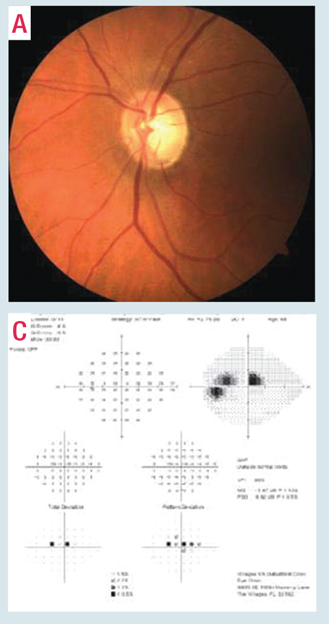 Despite relatively mild inferior temporal neuroretinal rim loss in this patient’s right eye (A) with confirmed RNFL loss on OCT, and regardless of the status of the rest of the visual field, this patient has advanced visual field loss on 24-2 visual field testing (C). Due to this deep central involvement, 10-2 visual field testing is critical to better understand the significance of this defect and monitor for progression.