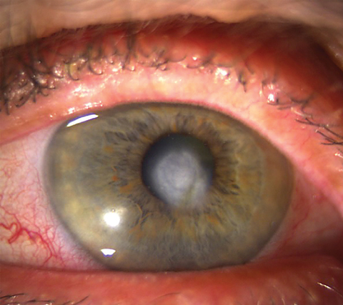 Significant scarring from deep corneal inflammation, which is one of the most common causes of vision loss in HSVK. Photo: Lisa Martén, MD