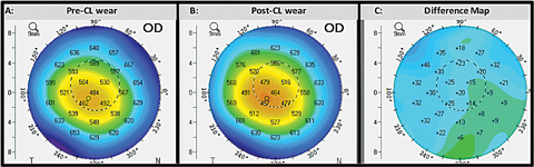 Fig. 4. This comparative display shows the corneal thickness displays of the same eye before (A) and after (B) initiating contact lens wear. The difference map (C) calculates the change in corneal thickness. 