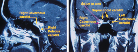 Sagittal MRI (left) shows an Internal carotid artery dissection in the wall of the petrous and cavernous sinus segments. Coronal MRI (right) shows significant narrowing of the carotid lumen in the cavernous sinus and supraclinoid segments of the right Internal carotid artery.