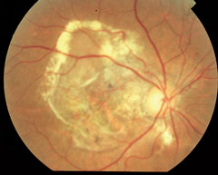 With dark adaptation, ODs may be able to begin management of AMD in the hopes of preventing progression to the advanced stages of AMD, as seen here.