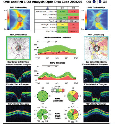 Fig. 1. The SD-OCT optic disc cube scan shows significant asymmetry in average thickness OD to OS. Superior temporal RNFL thinning is seen on the deviation map compared with normative data OS. The quadrant and clock hour plots show associated thinning OS.