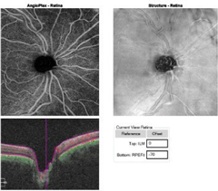 Fig. 3a. This OCT-A angioplex en face scan of the patient’s OD (left) with segmentation of the retina shows a dense microvascular network surrounding the right optic nerve.
