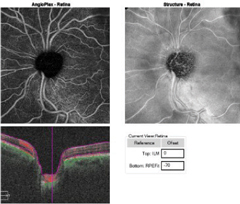 Fig. 3b. The OCT-A angioplex en face scan OS (right) with segmentation of the retina shows the significant dropout in the peripapillary capillary network greatest superior temporal to the optic nerve. 