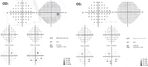 Fig. 5. These 24-2 visual field results show scattered point depressions OD and OS with good reliability. No glaucomatous cluster defects were noted OU. 