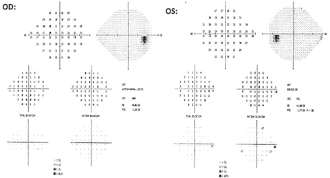 Fig. 3. The 24-2 testing revealed no glaucomatous clusters OD and no correlation to the new RNFL defect OD. An inferior nasal cluster defect was noted OS and did not correlate to structural OCT findings. This cluster was found to be non-repeatable over successive fields. 