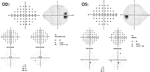 Fig. 4. Repeated 24-2 testing shows point depressions and no glaucomatous cluster defects OU.