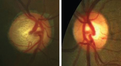 Unilateral glaucoma, as seen in these fundus photos, more severe in the right eye than the left, could elicit an APD in the right eye. Click image to enlarge. 