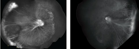 Fig. 2. Do these montage FA images of the patient’s right eye (at left) and left eye, taken under anesthesia, point to a diagnosis?
