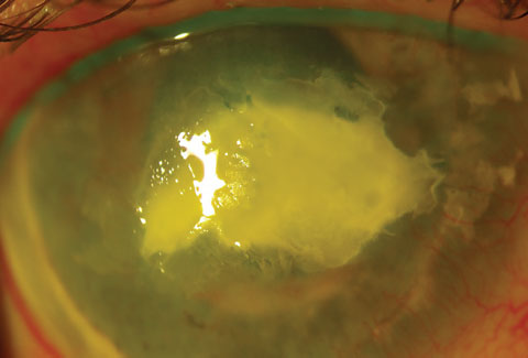 This image shows the same eye as seen in the previous image, post procedure. Unfortunately, the eye became phthisical and had to be enucleated.