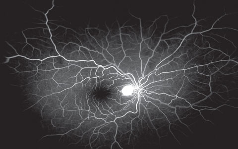 Fig. 4. This is the early venous phase of the fluorescein angiogram of our patient—note the hyperfluorescent lesion involving the optic nerve.