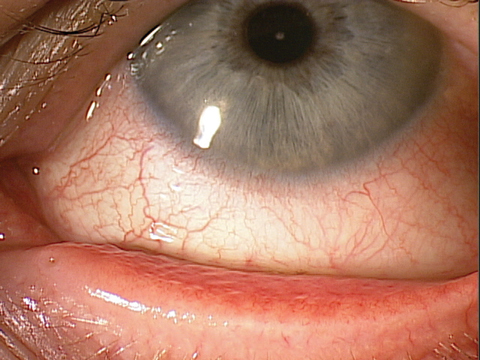 This patient’s red, irritated eye is a classic sign of allergic conjunctivitis.