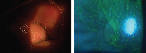 At left, this patient’s dry eye symptoms won’t resolve until the underlying floppy eyelid syndrome is treated. At right, this patient’s LSCD could be due to chemical burns and severe ocular scarring secondary to conditions such as Stevens-Johnson syndrome.