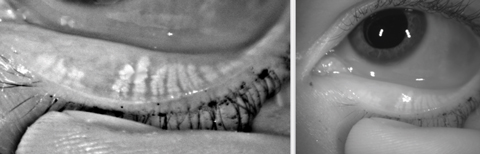 This 35-year-old female patient developed gland atrophy as a result of contact lens overwear.
