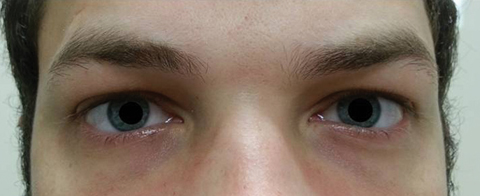Fig. 2. The patient’s pupils were dilated 8.5mm with no reactivity in the right or left eyes. 
