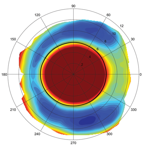 This scleral elevation map shows an asymmetric, atoric sclera, which can lead to poor scleral alignment with spherical or toric haptic lenses. In this case, a sector-specific lens may provide an improved fit. Image: Jason Jedlicka, OD