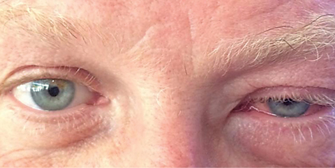 This patient presented with a unilateral ptosis, edema and injection, characteristic of viral conjunctivitis. 