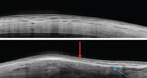 These images show a normal sclera, above, vs. nodular episcleritis, below. Note the increased thickness of the episclera (red arrow) while the scleral thickness is unaffected. The elongated hyporeflective area (blue arrow) could indicate edema in the presence of a thickened sclera. In this case, it was due to a scleral plaque.